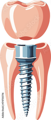 Realistic medical illustration of a dental implant showing a titanium screw integrated into the tooth root structure, used for educational and dental care materials.