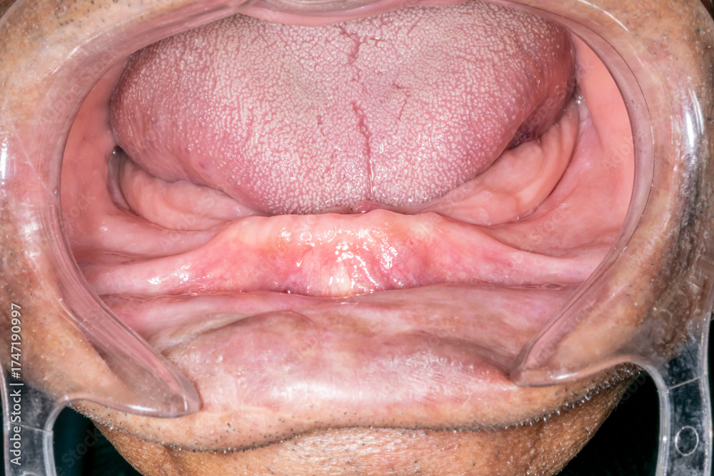 Fototapeta premium An elder dentistry patient case open mouth, lips retracted with a plastic cheek retractor. Close up front view showing an edentulous and atrophied anterior mandibular arch.