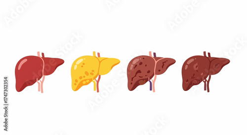 Illustration depicting the progression of liver disease, showing healthy, fatty, damaged, and cirrhotic livers side-by-side.