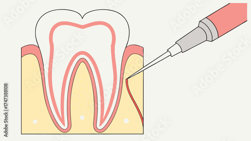 Dental procedure illustration tooth anatomy gum treatment injection dentistry infographic oral hygiene medical diagram healthcare tooth root enamel dentin gingiva periodontal disease.