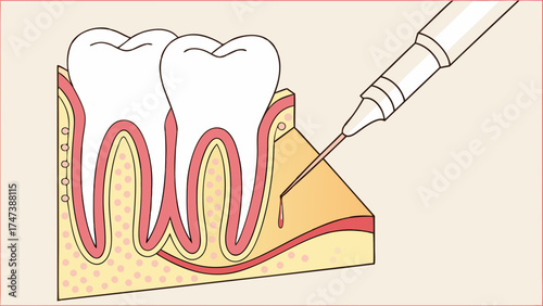 Dental Injection Illustration Anatomy of a Tooth and Gum with Needle.