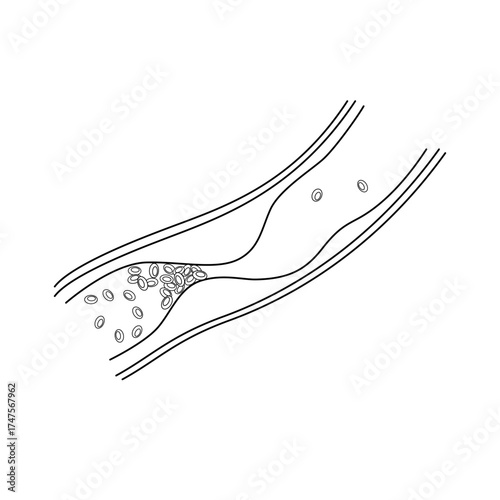 Blocked artery drawing llustration. Atherosclerosis, infarct, ischemia, thrombosis disease. blocked vascular, cholesterol,. vector illustration for medical, symbol, clinic, education.
