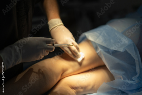 Close-up of sclerotherapy injection for varicose veins performed by vascular surgeon in clinic.