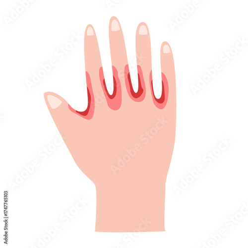 Athlete's Foot disease concept