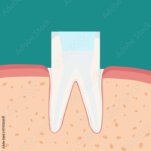 치아 신경치료와 충치치료 tooth root canal treatment