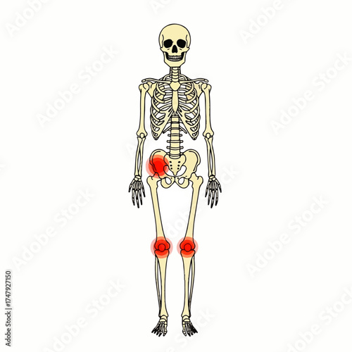 A full human skeleton illustration with red highlighting on the hip and knee joints, indicating pain or inflammation.