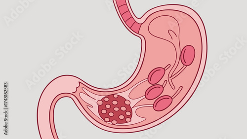 Medical Illustration of Stomach with Tumor Digestive System Anatomy Healthcare Internal Organ Diagram.