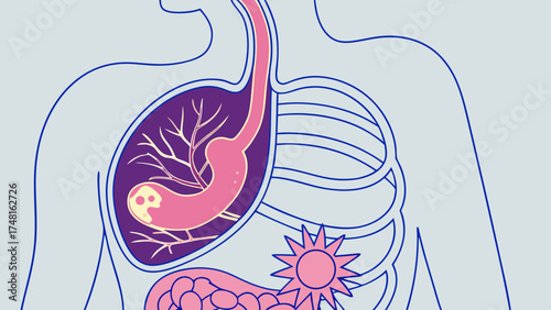 Medical illustration of the human digestive system stomach anatomy gastric ulcer internal organs healthcare disease illness biology anatomy chart human body medical diagram educational.