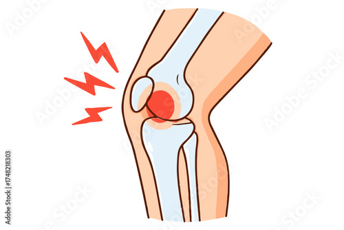 Illustration depicting knee pain with a red inflamed joint and radiating pain signals