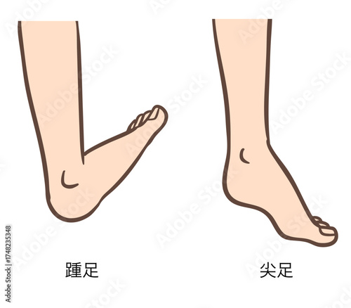 足関節の変形、踵足と尖足