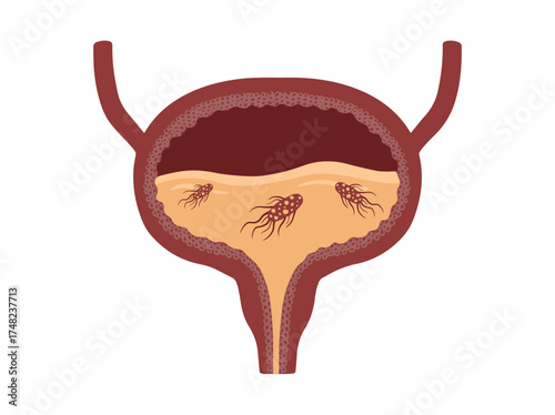 Bladder Infection Bacteria Virus