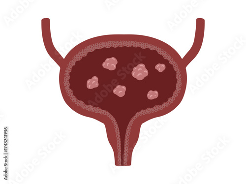 Bladder Polyps Illustration