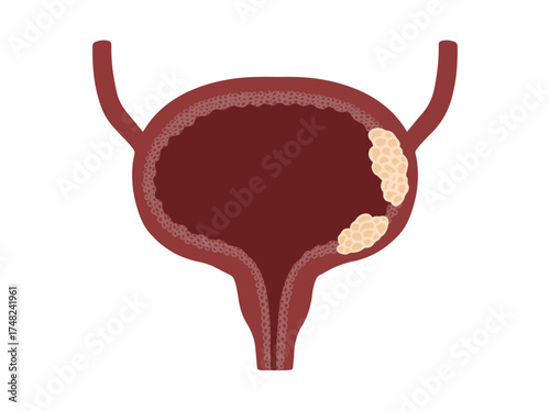 Bladder Cancer Illustration