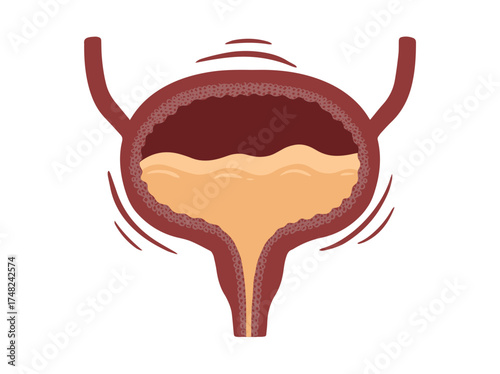 Bladder Urge Incontinence Illustration