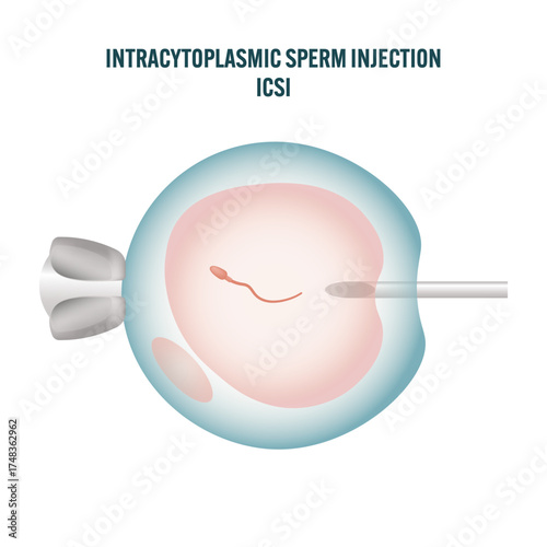 Intracytoplasmic sperm injection ICSI procedure illustration — medical fertilization process showing sperm injected into egg cell, IVF and assisted reproductive technology educational diagram biology