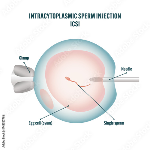 Labeled intracytoplasmic sperm injection ICSI diagram — educational medical illustration showing sperm injection into egg cell, IVF fertilization process, assisted reproductive technology infographic