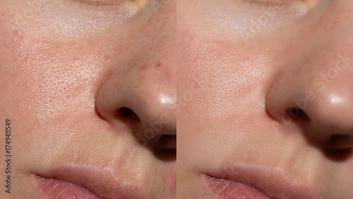 Side-by-side comparison of female skin texture showing pores and redness before and after treatment. Ideal for skincare, cosmetic results, dermatology or advertising.