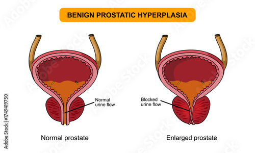Illustration of benign prostatic hyperplasia. Normal bladder and BPH. Pain in the male reproductive system. Prostate gland and bladder. Vector illustration for medical posters, clinics, and education