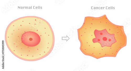 Cancer cell and healthy, normal. cell Cancerous cells have unique features, including a large nucleus with an irregular shape and prominent nucleoli. Vector illustration