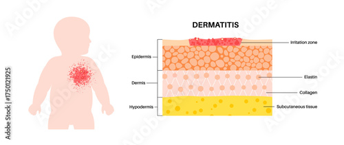 Dermatitis skin disease