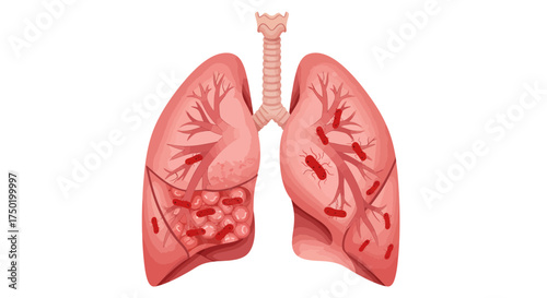 Detailed anatomical illustration of infected lungs with visible bacteria, perfect for medical education and health awareness campaigns about respiratory illnesses