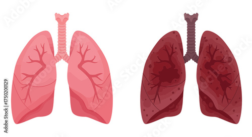 Healthy lungs and unhealthy lungs comparison for medical education, showing damage from smoking or disease, useful for health awareness campaigns