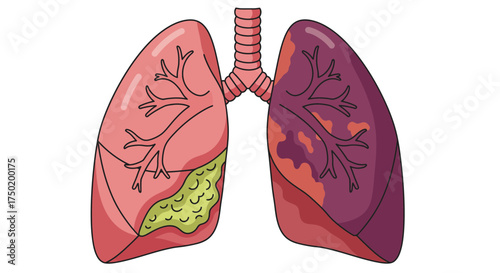Illustrative lungs showing damage, emphasizing respiratory health, perfect for medical educational content, anatomical study, or promoting awareness of lung disease