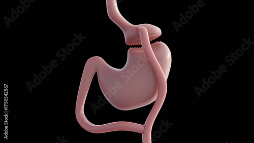 Photos A 3d image illustrates gastric bypass surgery that change digestive system to help lose weight