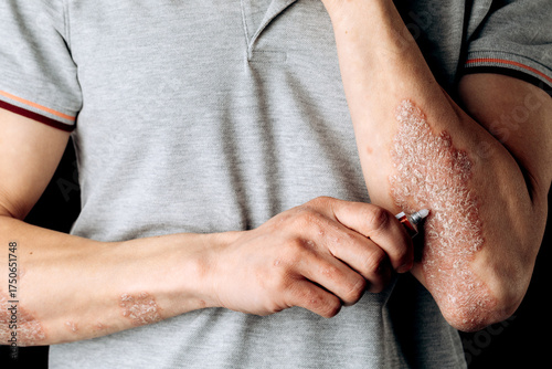 The use of an emollient on dry, flaky skin, as in the treatment of psoriasis, eczema and other dry skin