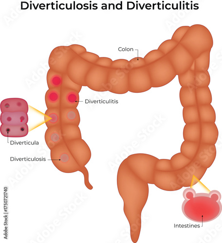 Diverticulosis and Diverticulitis Colon Conditions Explained