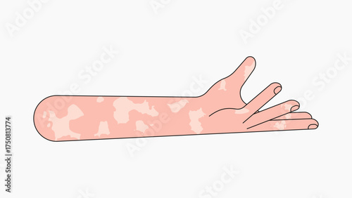 Vitiligo presenting hand gesture, flat collage element vector
