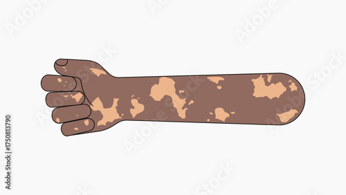Vitiligo fist arm, gesture flat collage element vector