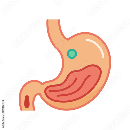 Anatomical illustration of a human stomach with a small teal circular growth depicted on the upper exterior surface alongside the digestive tract and