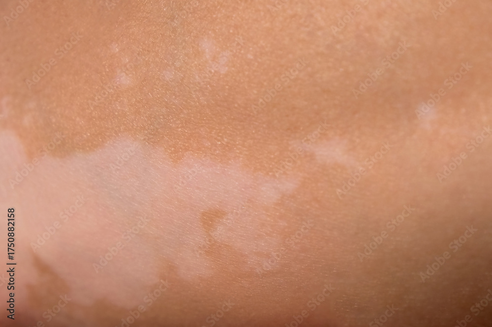 Fototapeta premium Skin with vitiligo. Female legs and arms with autoimmune disease. depigmentation