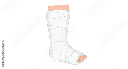 Illustration of a leg encased in a white plaster cast used for fracture healing and immobilization, showing the toe area exposed for circulation