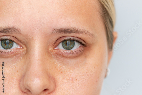 Close-up of a tired young woman's eyes with dark circles and pigmentation spots. Natural skin texture, no makeup. Real beauty and skincare awareness concept