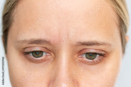 Close-up of a young woman's forehead showing a glabellar line (frown wrinkle) between her eyebrows. Natural expression, visible skin texture. Aging, skincare, or emotional stress concept
