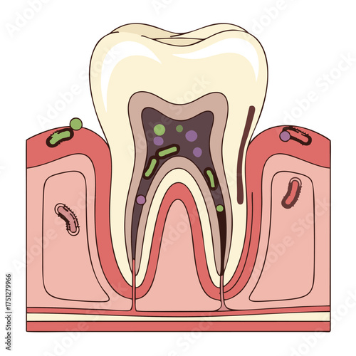 Detailed Anatomical Illustration of a Diseased Human Tooth with Cavity and Gums.