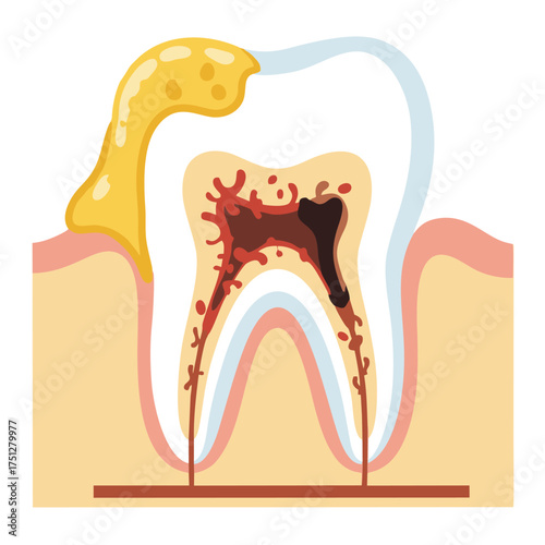 Detailed Anatomical Illustration of a Diseased Tooth with Cavity and Infection.