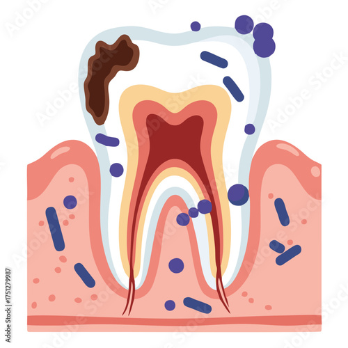 Detailed cross-section of a decaying tooth with visible bacteria and gum inflammation.