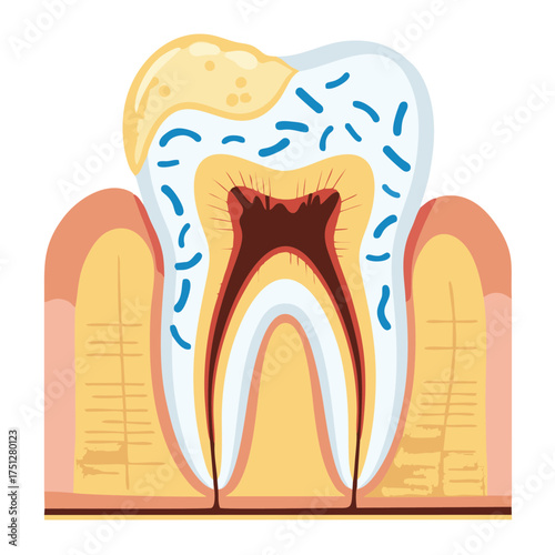 Human Tooth Anatomy Cross-Section with Visible Plaque and Germs.