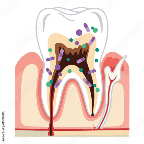 Human Tooth Cross-Section with Severe Decay, Bacteria, and Infected Pulp.