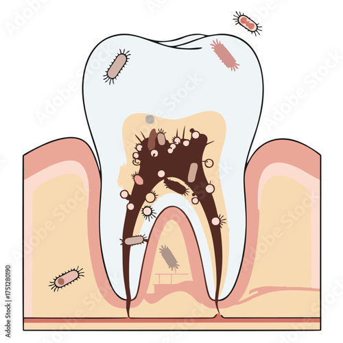 Illustration of a Decayed Tooth Infested with Bacteria and Cavities.