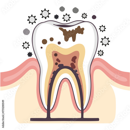 Tooth with Cavity and Bacteria Illustration.