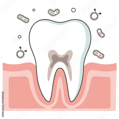 Tooth with Decay and Bacteria Illustration in Pink Gums.