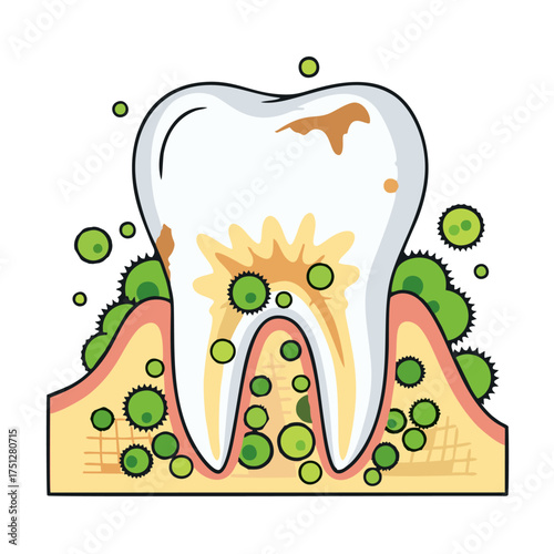 Cartoon tooth showing plaque, tartar, and bacteria on gums, illustrating dental hygiene issues.