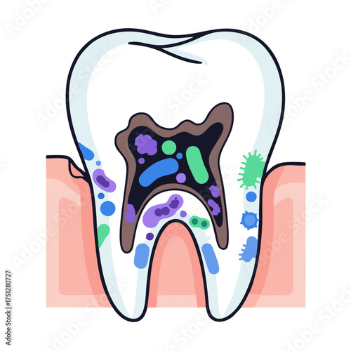 Cartoon Tooth with Cavity Filled with Bacteria and Decay.