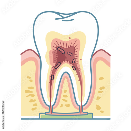 Cross-section of a molar tooth showing severe pulp infection and decay, with visible bacteria.