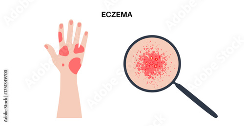 Dermatitis skin disease