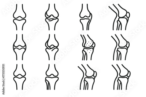 Knee joint diagrams: healthy vs. arthritic conditions in side and front views